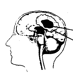 stroke